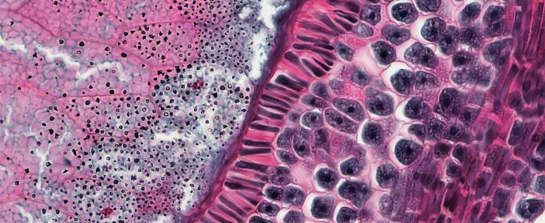 Cutaneous squamous cell carcinoma: UNLOXCYT’s long-term data